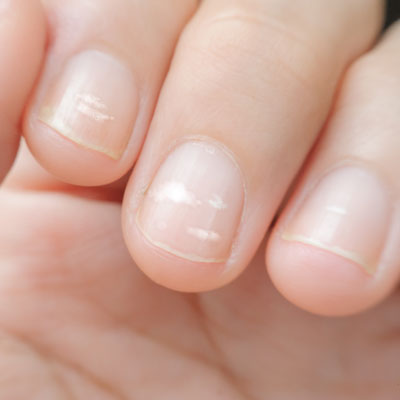 Nahaufnahme von Fingernägeln mit weißen Flecken auf den Nagelplatten – helle, neutrale Aufnahme